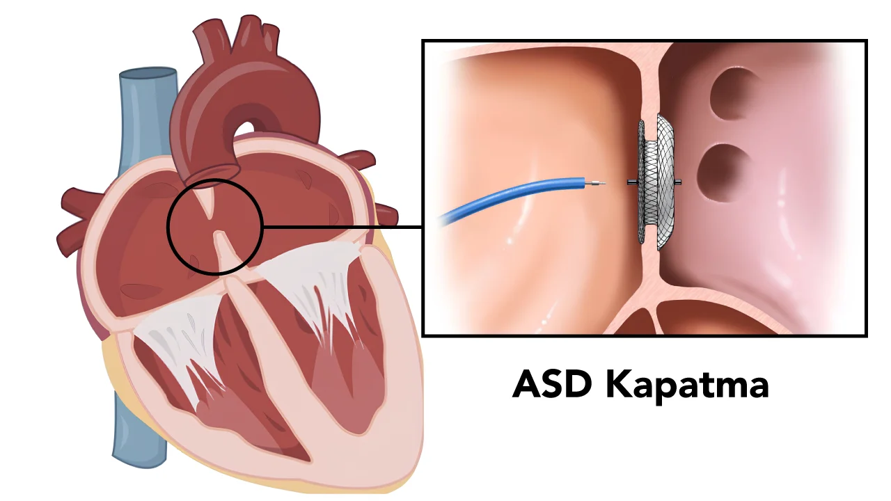 Ameliyatsız ASD Kapatma