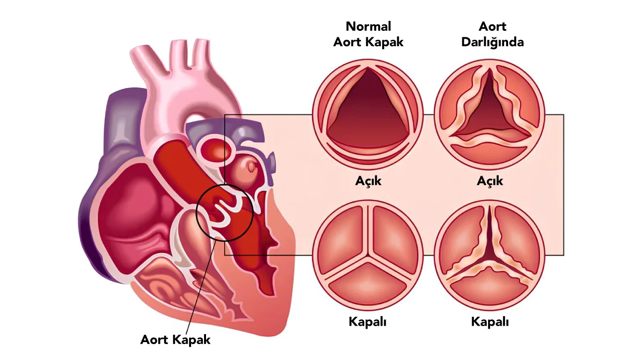 Aort Kapak Darlığı (Aort Stenozu)