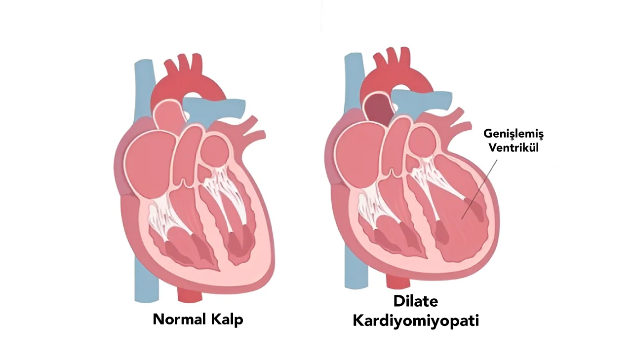 Dilate Kardiyomiyopati (DKMP)