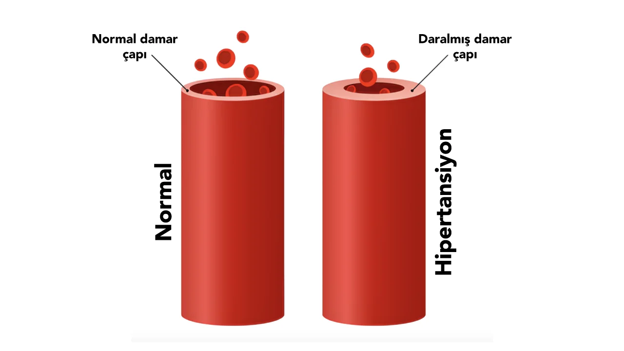 Hipertansiyon (Yüksek Tansiyon)