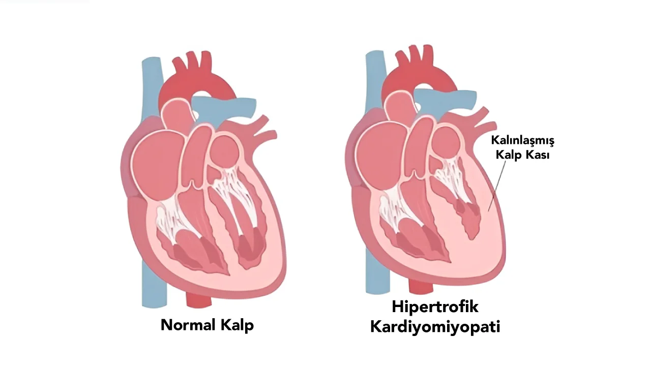 Hipertrofik Kardiyomiyopati (HKMP)