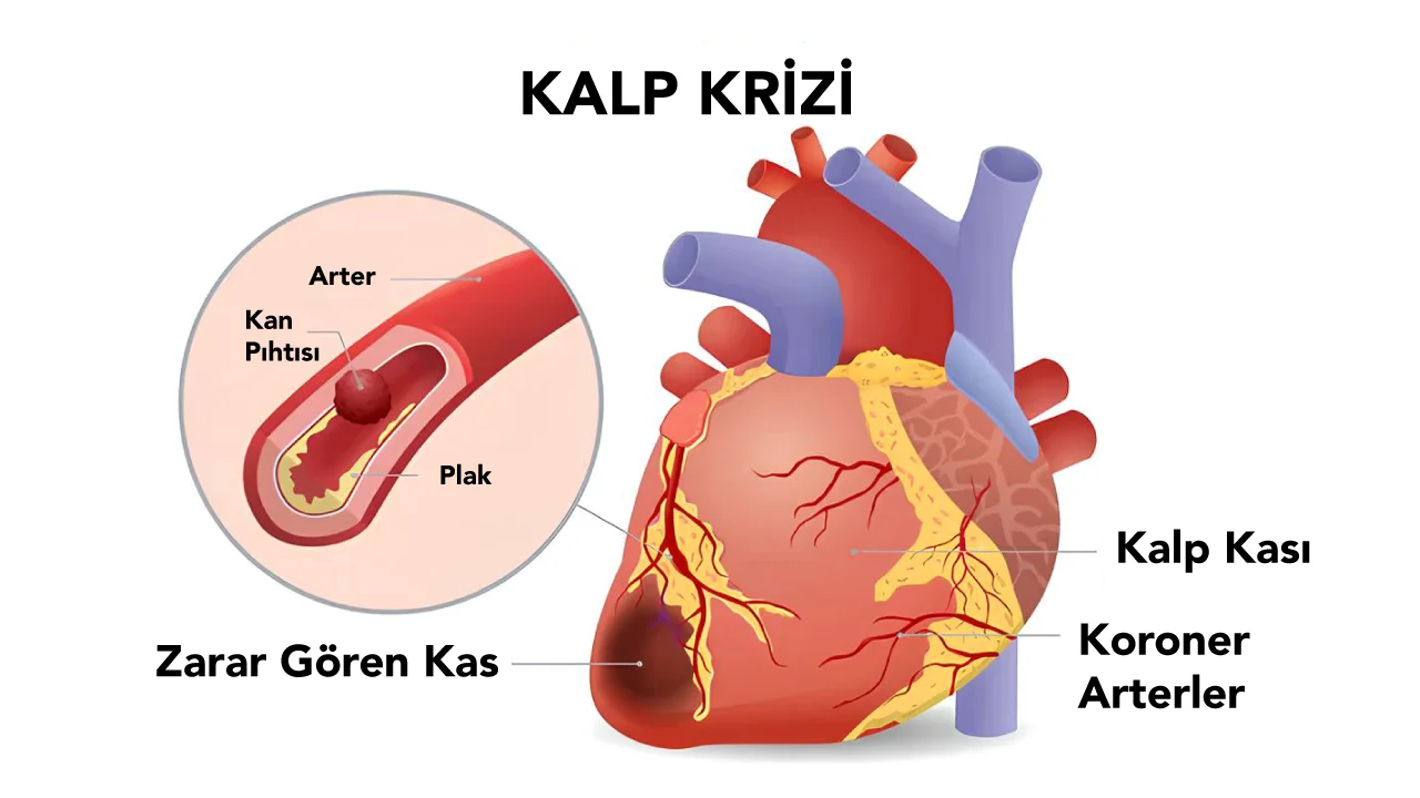 Kalp Krizi