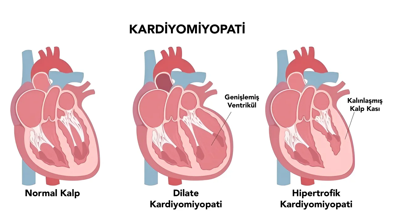 Kardiyomiyopati