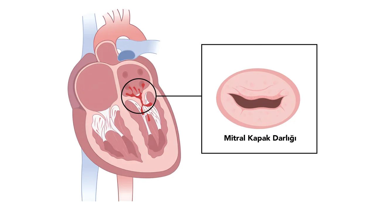 Mitral Kapak Darlığı (Mitral Stenoz)