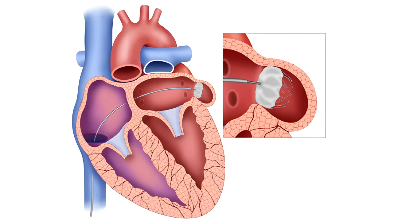 Sol Atriyal Apendiks Kapatma (LAA Kapatma)