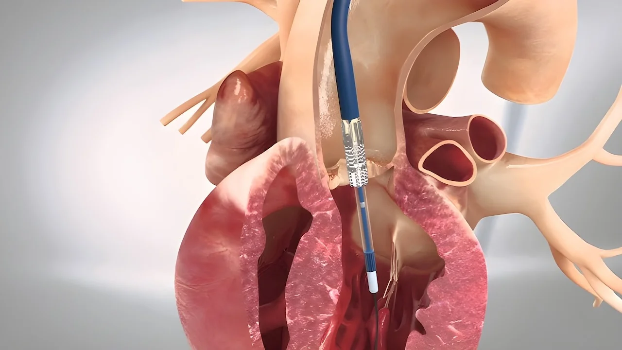 Transkateter Aort Kapak İmplantasyonu (TAVI)