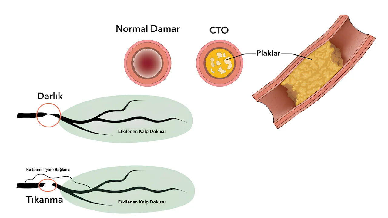 Kronik Total Oklüzyon (CTO)