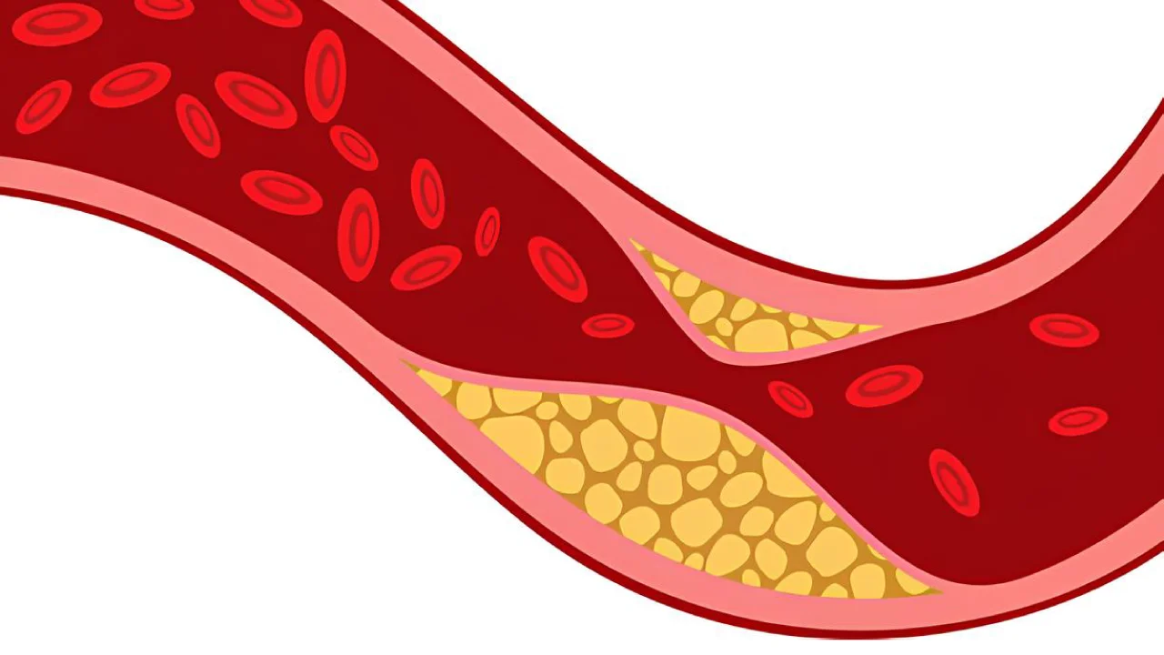 Kolesterol (Damar duvarında kolesterol birikmesini görüyorsunuz)