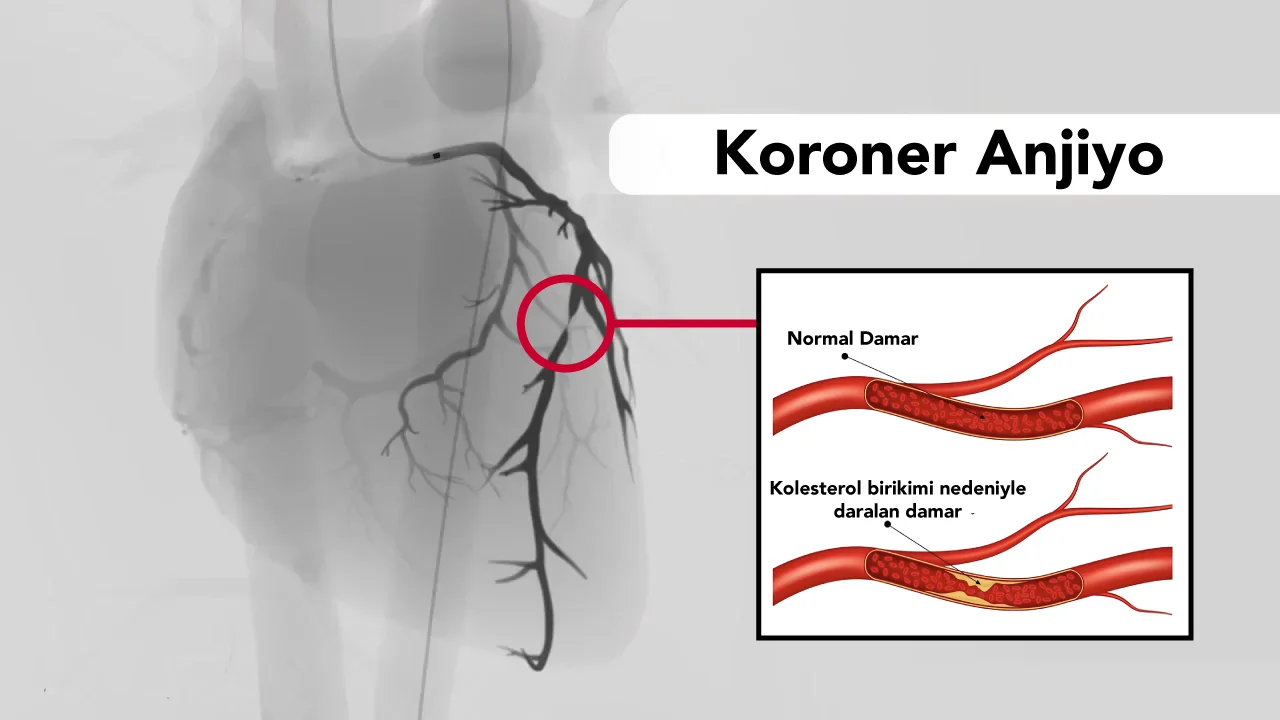 Korone Anjiyografi (Anjiyo)