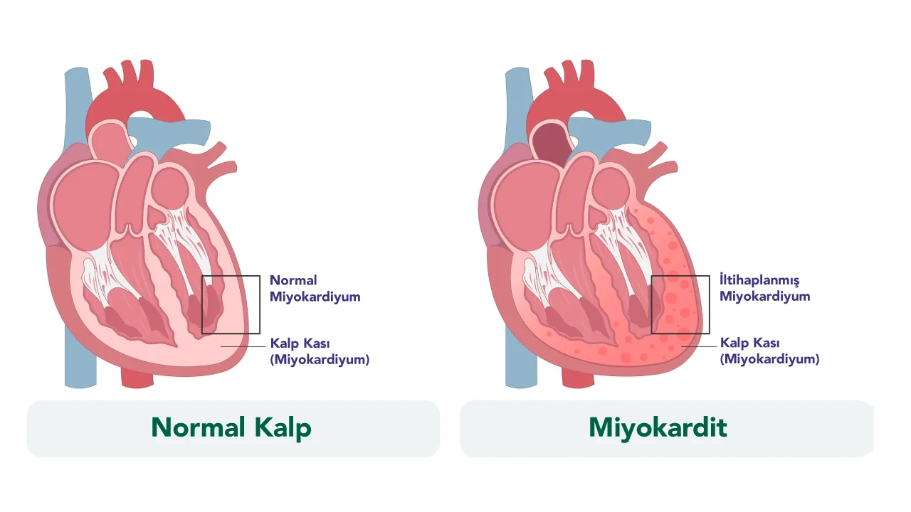Miyokardit (Kalp kası iltihabı)