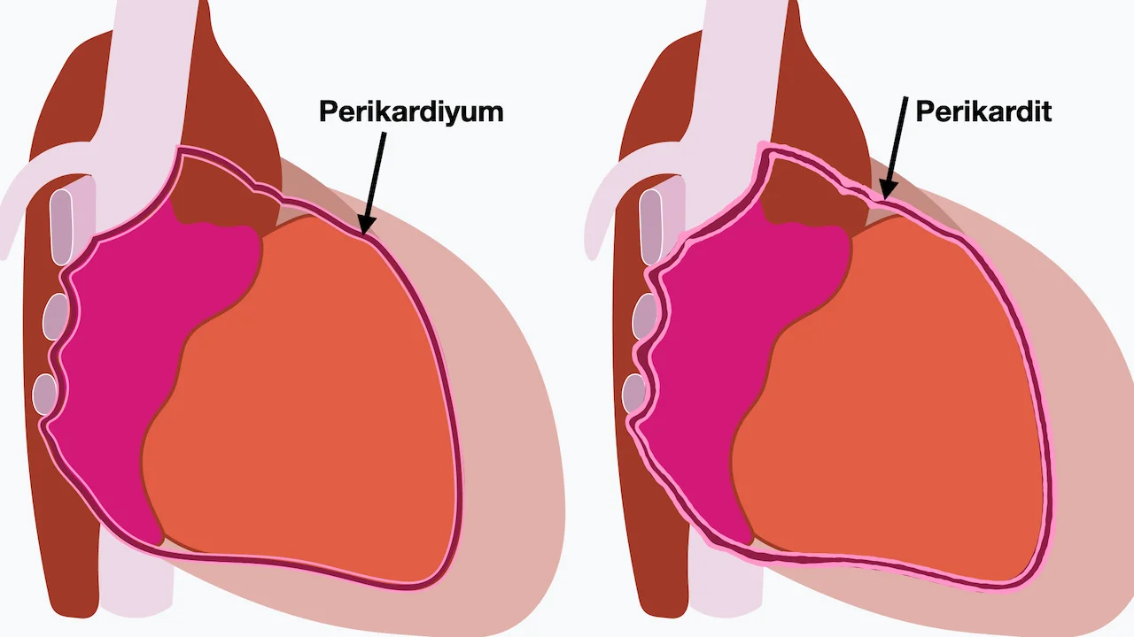 Perikardit (Kalp zarı iltihabı)