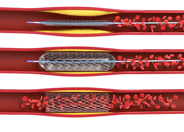 Balon anjiyoplasti ve stent