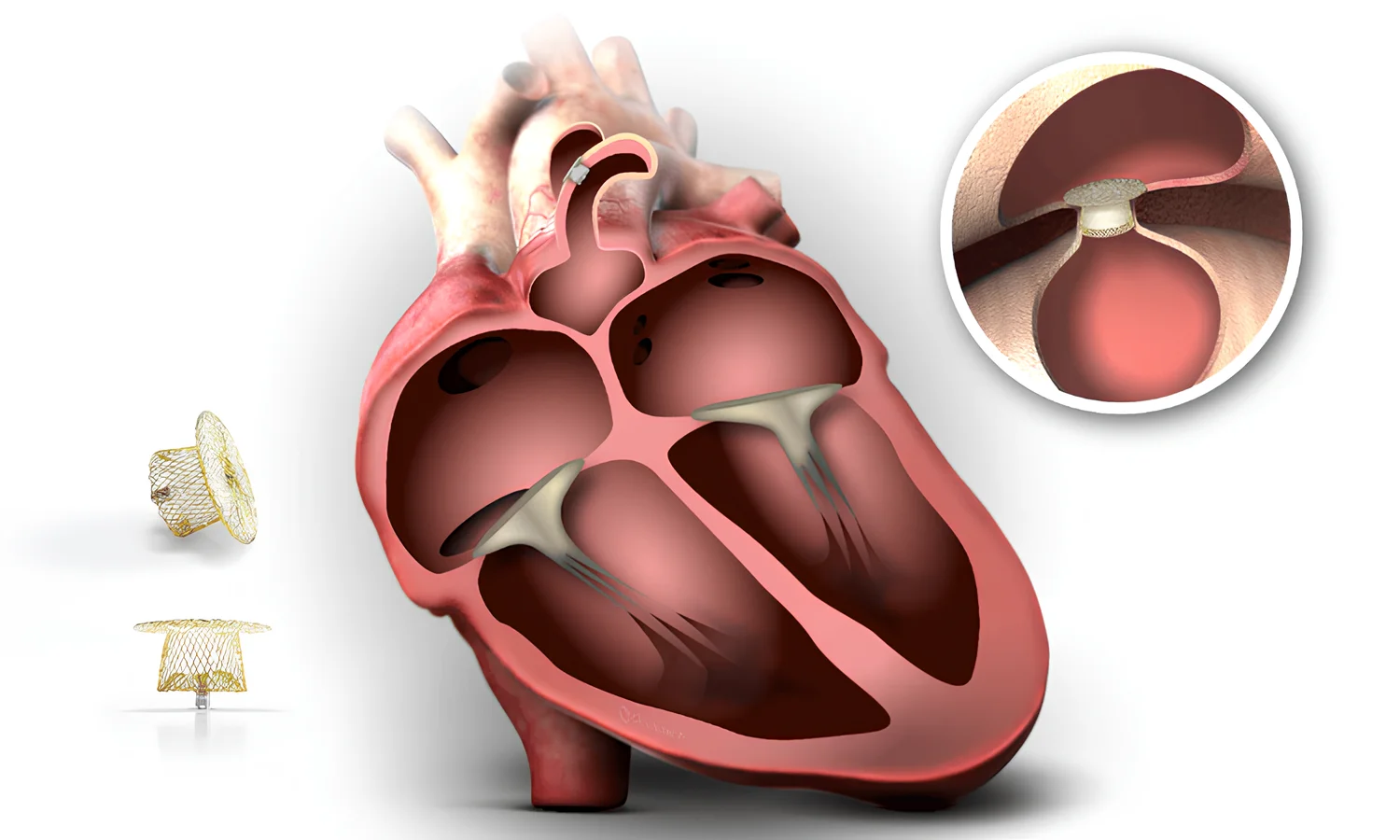 Ameliyatsız PDA Kapatma