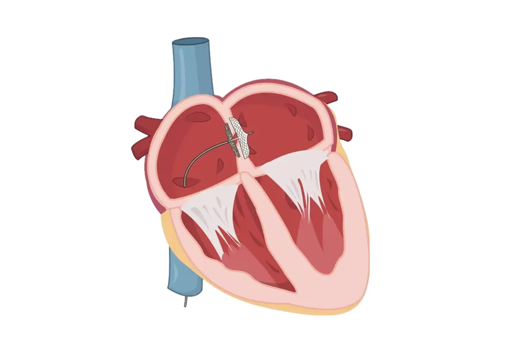 Ameliyatsiz PFO (Patent Foramen Ovale) Kapatma