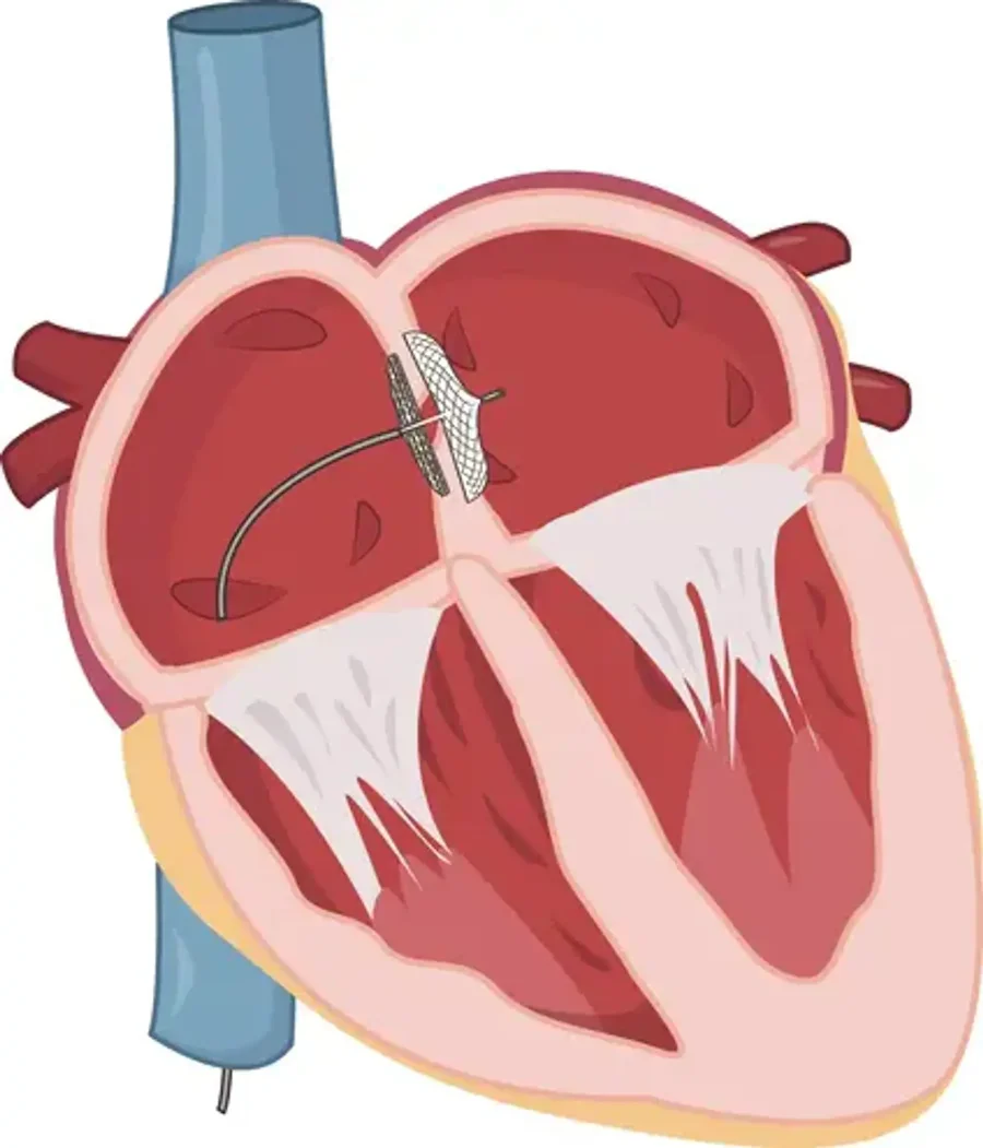 Ameliyatsiz Patent Foramen Ovale (PFO) Kapatma