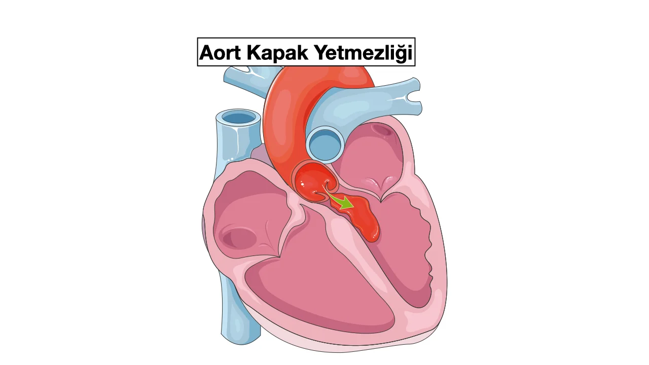 Aort Kapak Yetmezliği