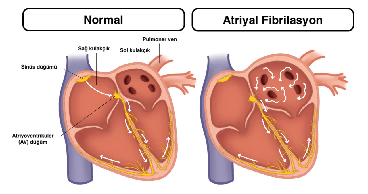Atriyal fibrilasyon (AF)