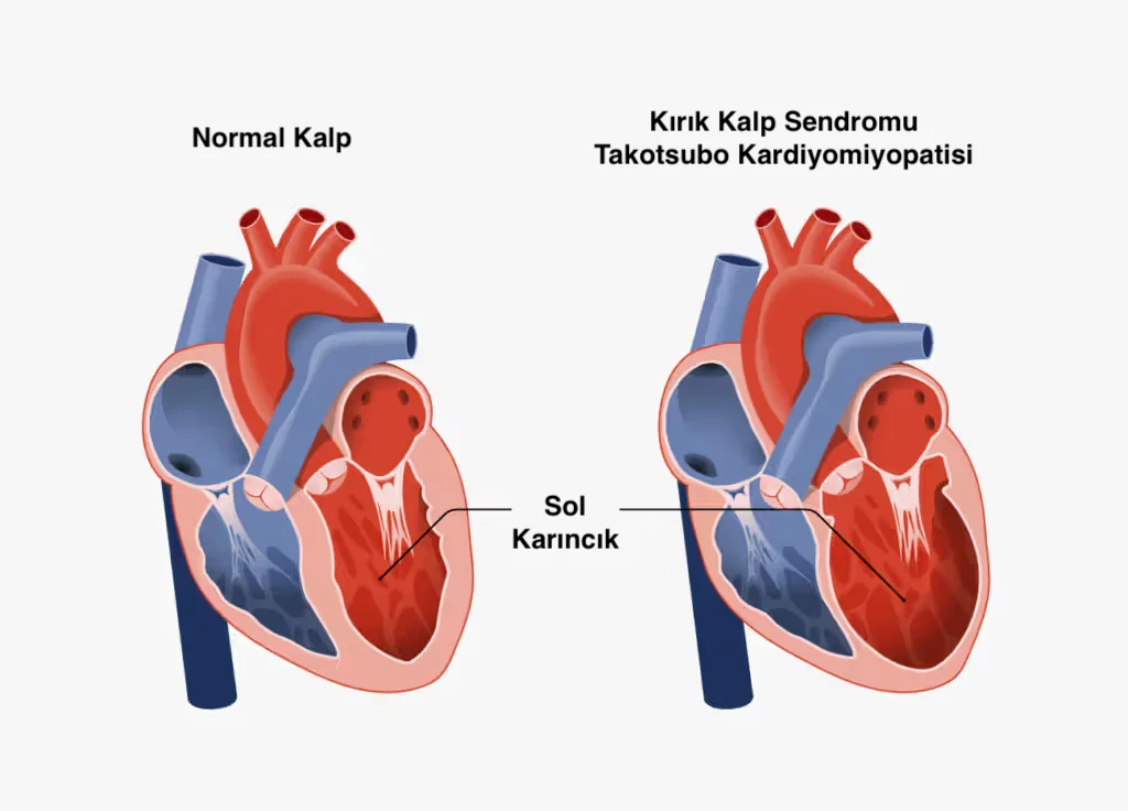 Kırık Kalp Sendromu