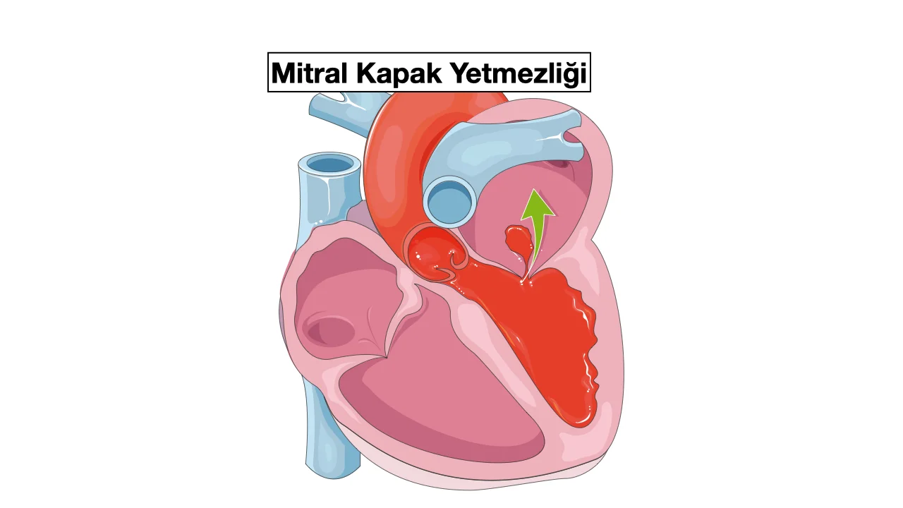 Mitral Kapak Yetmezliği