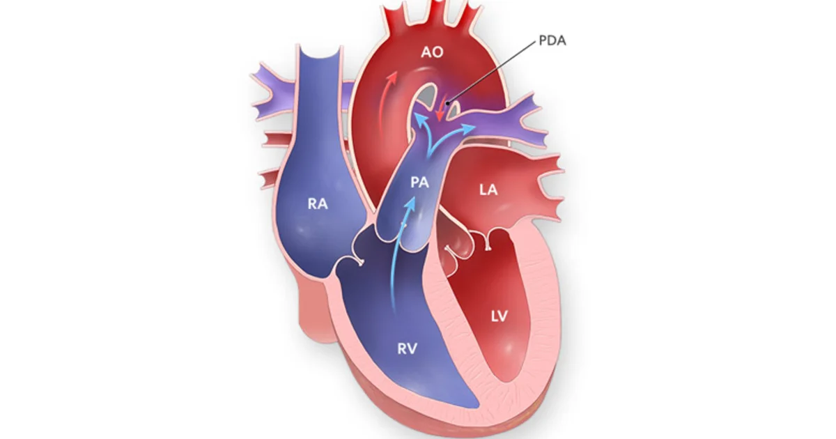 Patent Duktus Arteriyozus (PDA)