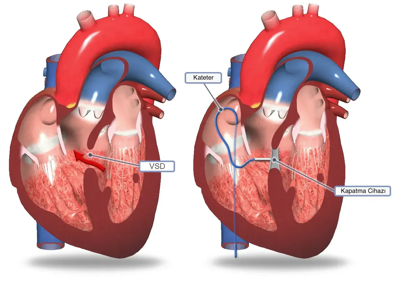 Ventriküler Septal Defekt (VSD) Kapatma