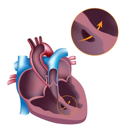 Ventriküler septal defekt (VSD)