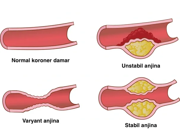 Anjina pektoris (Göğüs ağrısı)