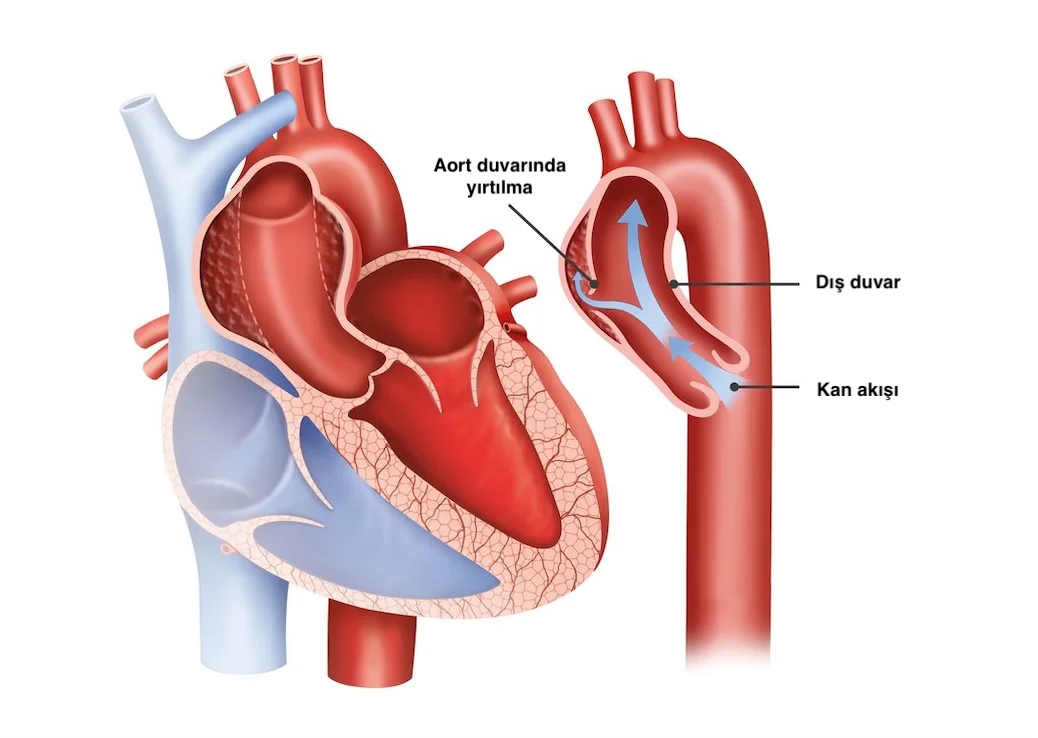 Aort Diseksiyonu (Aort Damarının Yırtılması)