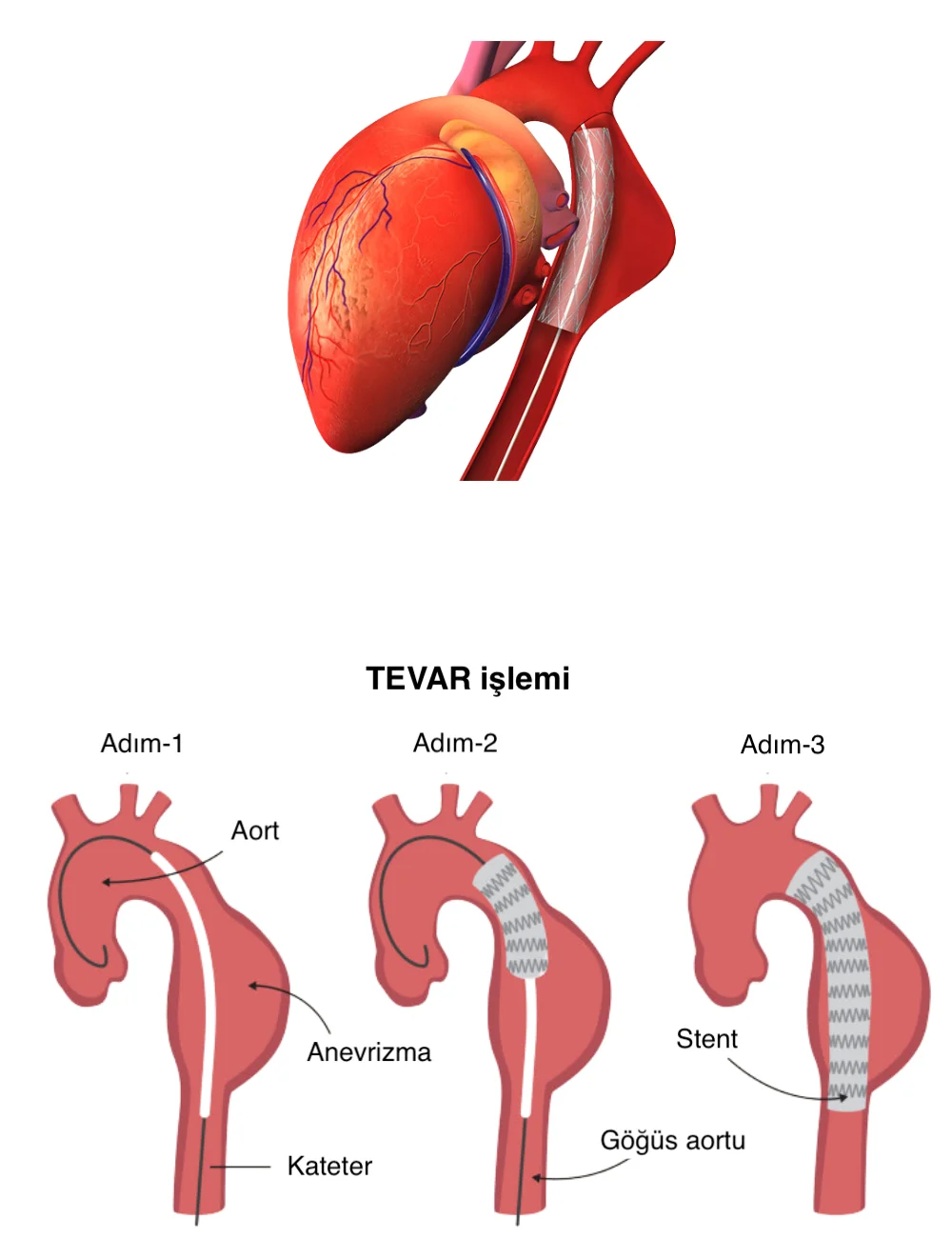EVAR ve TEVAR işlemi