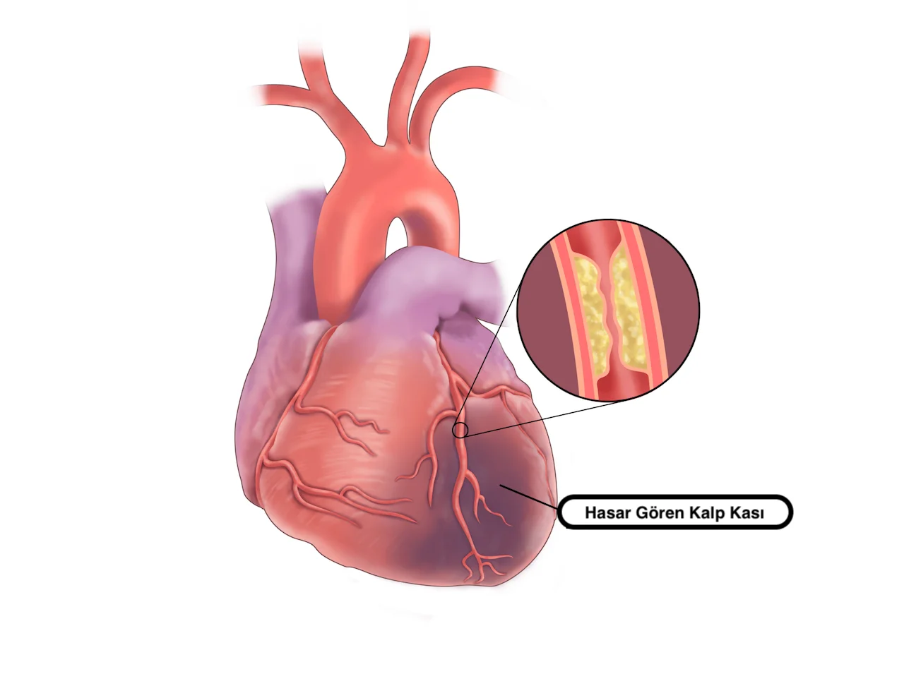 Kalp krizi riski nasıl azaltılır?