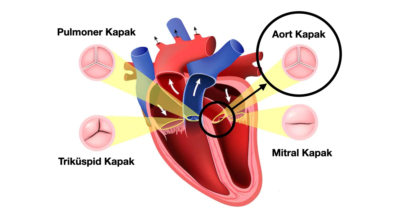 Aort Kapak Hastalığı
