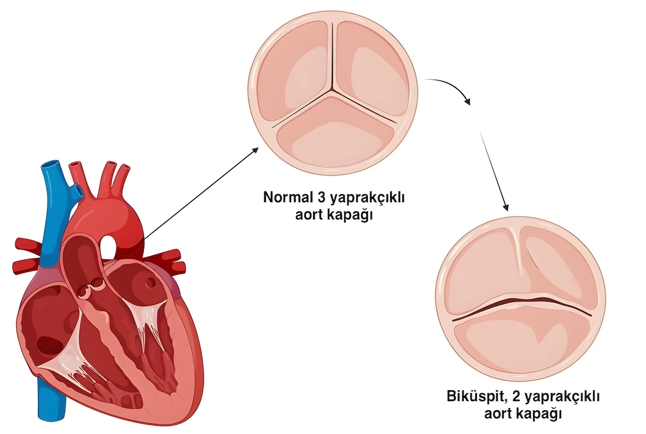 Biküspit Aort Kapak