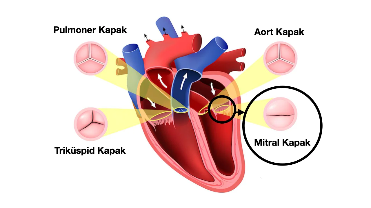 Mitral Kapak Hastalığı