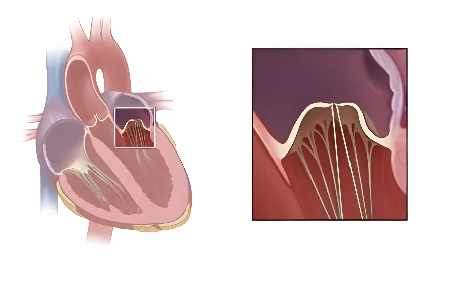 Mitral Kapak Prolapsusu