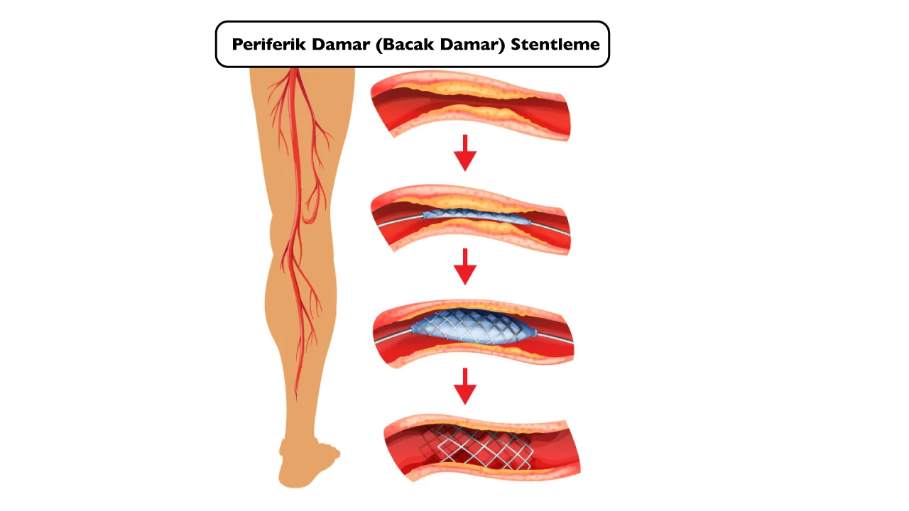 Periferik Damar (Bacak Damarı) Stentleme