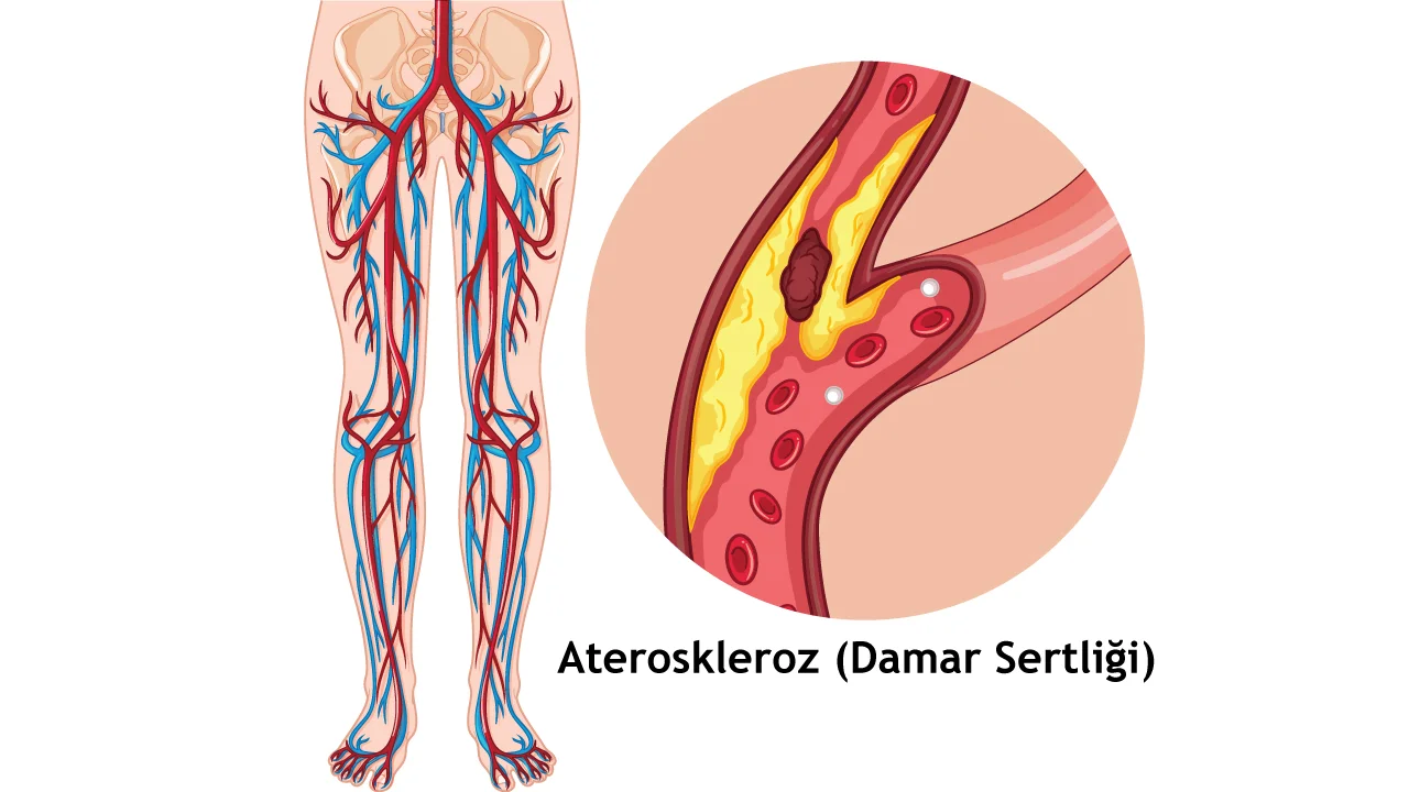 Periferik Damar Hastalığı